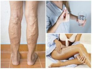 Varices nas pernas e métodos de tratamento