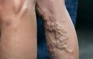 Varices nas pernas