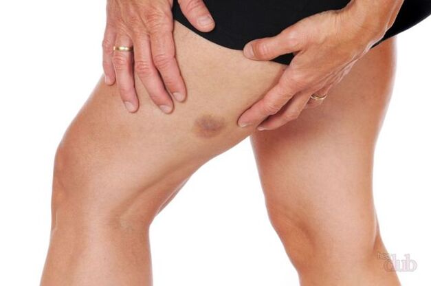 cando rebenta unha vea